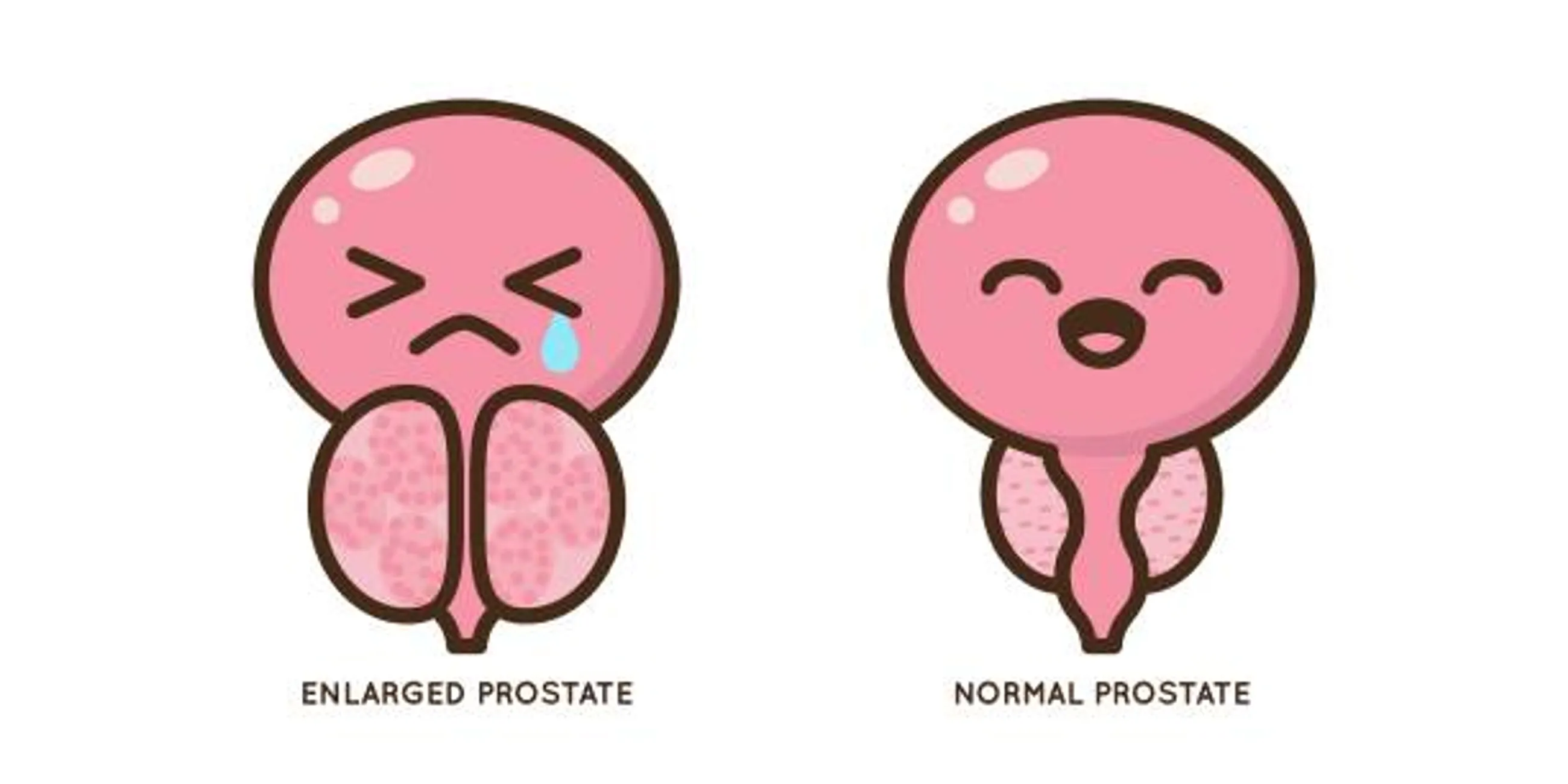 Benign prostatic hyperplasia (BPH)